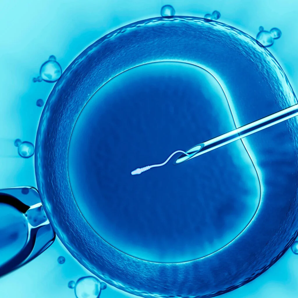 ICSI Treatment – Intracytoplasmic Sperm Injection Madurai