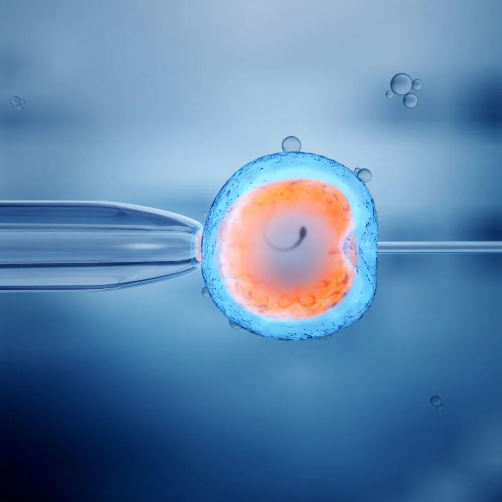IUI Treatment – Intrauterine Insemination Madurai